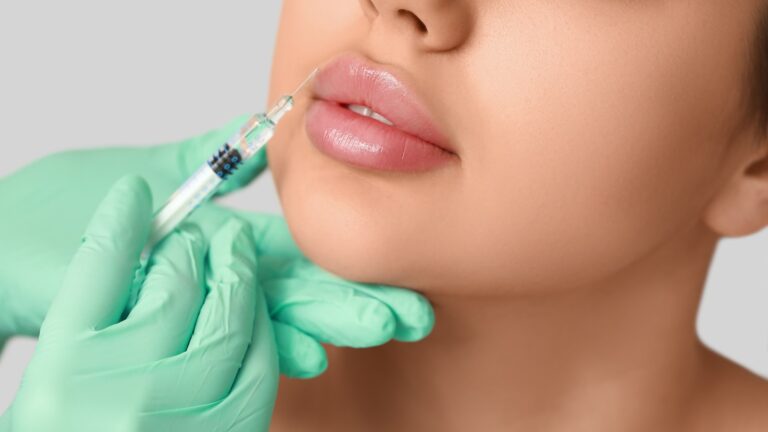 Lippenunterspritzung mit Hyaluronsäure — Filler Migration erkennen und korrigieren, Praxisklinik am Schwarzwald Lauchringen