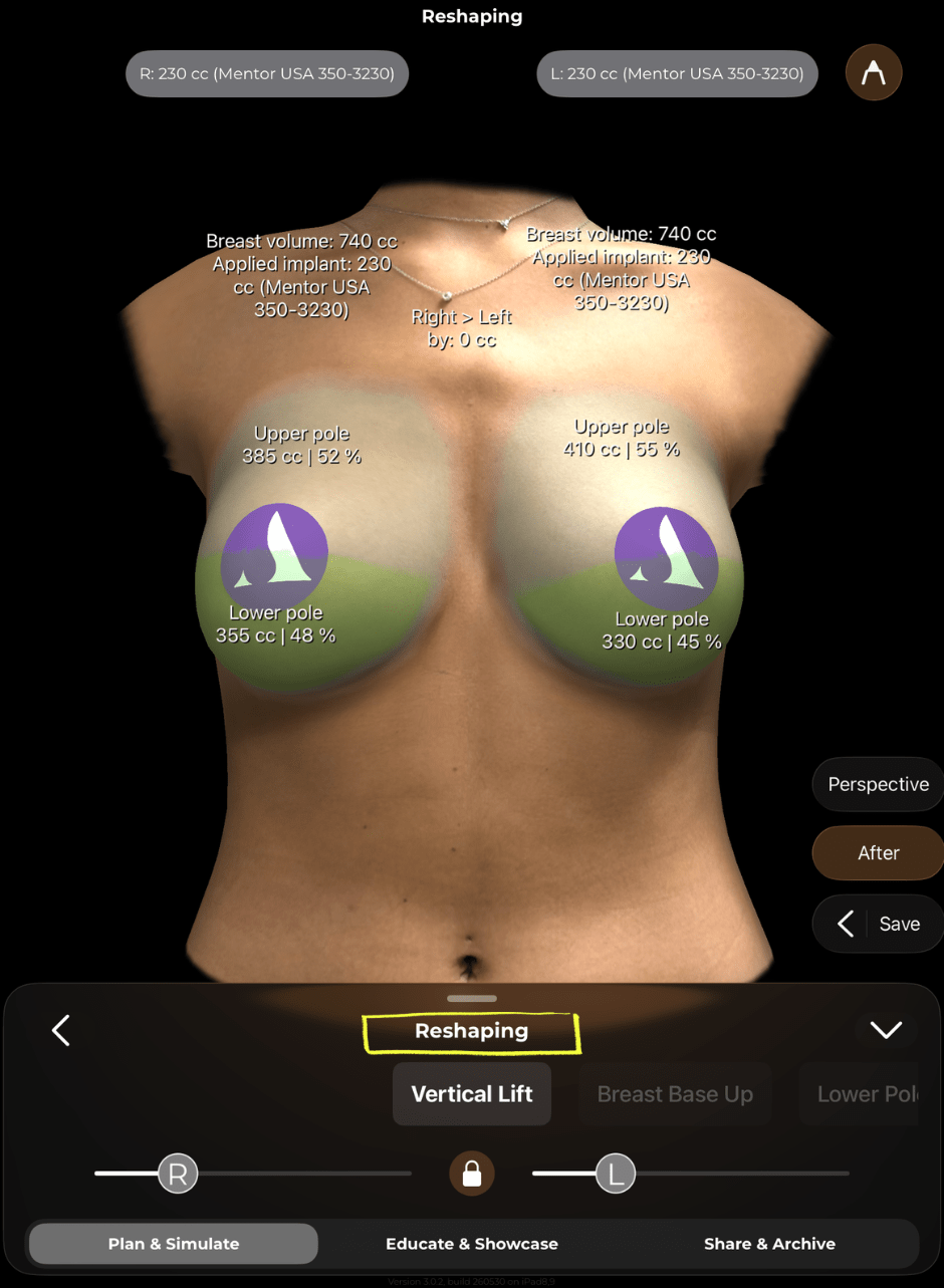 Arbrea Breast: beispielhafte Darstellung von Form und Volumen