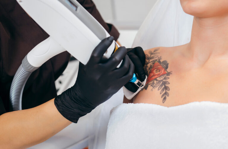 Laserbehandlung eines roten und schwarzen Tattoos an der Schulter