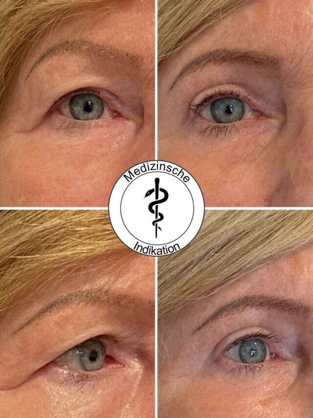 Vorher-Nachher-Bilder einer medizinischen Indikation für eine Oberlidstraffung. Wie findet ihr das Ergebnis 🤩?
 
‼️ Medizinische Indikation.: ICD H53.4

✨ Beste Qualität und höchste Sicherheit durch Klinikstandard ✨

☎️ +49 7741 835 825
📧 Info@klinik-schwarzwald.com
📍Klinik am Schwarzwald
Hauptstr. 31
79787 Lauchringen
🌍 www.klinik-schwarzwald.com

#drholdenried #plastischechirurgie #schönheitsklinik #beautydoc #beauty #schönheitsop #basel #klinikamschwarzwald #plasticsurgery #waldshuttiengen #lauchringen #rheinfelden #rheinfelden #zürich #oberlid #oberlidstraffung