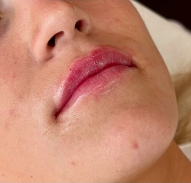 💋 Natürlich schöne Lippen – mit dem gewissen Extra
Ob dezente Betonung oder sinnliche Fülle – bei der Lippenunterspritzung kommt es auf Präzision, Gefühl und ein ästhetisches Gespür an.

In unserer Klinik steht ein natürliches Ergebnis im Vordergrund – individuell abgestimmt auf die Gesichtsharmonie und Wünsche jeder Patientin.

✨ Beste Qualität und höchste Sicherheit durch Klinikstandard ✨

☎️ +49 7741 835 825
📧 Info@klinik-schwarzwald.com
📍Klinik am Schwarzwald
Hauptstr. 31
79787 Lauchringen
🌍 www.klinik-schwarzwald.com

#drholdenried #plastischechirurgie #schönheitsklinik #beautydoc #beauty #schönheitsop #basel #klinikamschwarzwald #lippenunterspritzung #lippen #lipsfillers #plasticsurgery #waldshuttiengen #lauchringen #rheinfelden #rheinfelden #zürich