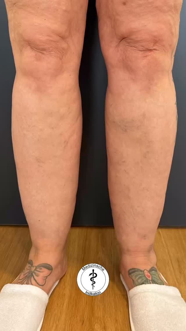 Medizinische Indikation‼️

Lipödem – mehr als nur ein ästhetisches Problem
Das Lipödem ist eine chronische Fettverteilungsstörung, die ausschließlich Frauen betrifft. Es kommt zu einer symmetrischen Vermehrung von Fettgewebe – häufig an Beinen und Armen – begleitet von Druckempfindlichkeit, Spannungsgefühl und Schmerzen. Bewegung oder Diäten führen in der Regel nicht zu einer Besserung, da die Ursache nicht in Übergewicht, sondern in einer krankhaften Fettgewebsvermehrung liegt.

Auf den Bildern sehen Sie das Ergebnis einer medizinisch indizierten Absaugung (Liposuktion) der Waden bei Lipödem. In diesem Fall wurden 3,5 Liter erkranktes Fettgewebe entfernt. Die Operation erfolgte aus therapeutischen Gründen, nicht aus ästhetischen Motiven.

Die Patientin ist nun schmerzfrei, kann sich wieder frei bewegen und berichtet von einer deutlichen Verbesserung ihrer Lebensqualität. Neben der optischen Veränderung steht vor allem die Befreiung der chronischen Schmerzen im Vordergrund.

💙 Wichtig: Das Lipödem ist eine anerkannte Erkrankung – rechtzeitige Diagnose und individuell angepasste Therapie können das Fortschreiten verhindern und Betroffenen zu einem schmerzfreien Leben verhelfen.

✨ Power Assisted Liposuction – Präzision und Effizienz ✨

Bei der Power Assisted Liposuction (PAL) unterstützt ein sanft vibrierendes Handstück den Chirurgen dabei, Fettgewebe besonders präzise, gewebeschonend und effektiv zu entfernen. Diese Technik ermöglicht kürzere OP-Zeiten, eine gleichmäßige Konturierung und eine schnellere Erholung für unsere Patientinnen und Patienten.

In unserer Klinik führen wir sowohl ästhetische Fettabsaugungen zur harmonischen Körperformung als auch medizinisch indizierte Liposuktionen – z. B. bei Lipödem – durch.

✨ Beste Qualität und höchste Sicherheit durch Klinikstandard ✨

☎️ +49 7741 835 825
📧 Info@klinik-schwarzwald.com
📍Klinik am Schwarzwald
Hauptstr. 31
79787 Lauchringen
🌍 www.klinik-schwarzwald.com

#lipödem #drholdenried #beautydoc #schönheitsklinik #schönheitsop #lipödemfighter #lipo #klinikamschwarzwald