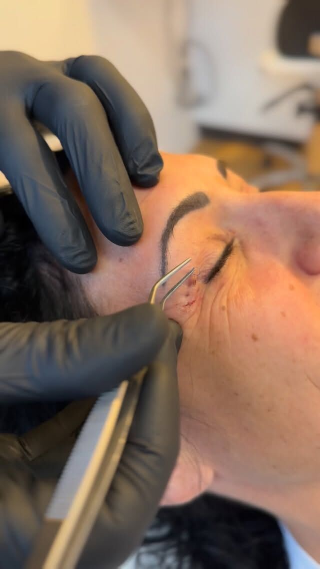 ✨ Oberlidstraffung – frischer Blick in kurzer Zeit ✨
Eine Oberlidstraffung sorgt für einen offenen, wachen und verjüngten Blick, indem überschüssige Haut und feine Fältchen im Lidbereich entfernt werden. Der Eingriff ist minimal-invasiv, dauert meist weniger als eine Stunde und hat einen schnellen Heilungsverlauf.

Bereits nach wenigen Tagen sind Schwellungen und Blutergüsse deutlich rückläufig, und nach etwa ein bis zwei Wochen ist man in der Regel gesellschaftsfähig. Das Ergebnis: ein natürlich frisches Aussehen ohne Veränderung der individuellen Mimik. 💫

✨ Beste Qualität und höchste Sicherheit durch Klinikstandard ✨

☎️ +49 7741 835 825
📧 Info@klinik-schwarzwald.com
📍Klinik am Schwarzwald
Hauptstr. 31
79787 Lauchringen
🌍 www.klinik-schwarzwald.com

#Oberlidstraffung #Blepharoplastik #FrischerBlick #ÄsthetischeChirurgie #NatürlichSchön #SchnelleHeilung