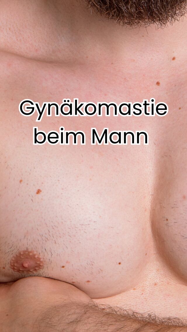 👨🏼‍⚕️ Gynäkomastie – wenn Männerbrust kein Tabuthema mehr ist

Viele Männer leiden still darunter: eine Vergrößerung der Brustdrüse, medizinisch Gynäkomastie genannt.
Sie kann hormonell bedingt sein, durch Medikamente entstehen – oder einfach genetisch veranlagt sein.

Wichtig: Gynäkomastie hat nichts mit Übergewicht allein zu tun.
Oft liegt tatsächlich Drüsengewebe vor, das sich auch durch Sport oder Ernährung nicht abbauen lässt.

🩺 Die Behandlung erfolgt chirurgisch – durch Entfernung des überschüssigen Drüsengewebes, meist kombiniert mit einer konturierenden Fettabsaugung.
Das Ergebnis: eine flache, maskuline Brust und deutlich gesteigertes Selbstbewusstsein. 💪🏼

Offen darüber zu sprechen ist der erste Schritt – denn Betroffene sind nicht allein.

✨ Beste Qualität und höchste Sicherheit durch Klinikstandard ✨

☎️ +49 7741 835 825
📧 Info@klinik-schwarzwald.com
📍Klinik am Schwarzwald
Hauptstr. 31
79787 Lauchringen
🌍 www.klinik-schwarzwald.com

#Gynäkomastie #Männerchirurgie #PlastischeChirurgie #ÄsthetischeChirurgie #BodyConfidence #Chirurgin #Männergesundheit #MedicalAesthetics
