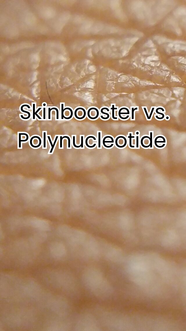 ✨ Skinbooster vs. Polynucleotide – was ist der Unterschied? ✨

Beide Behandlungen verbessern die Hautqualität und fördern die Hautverjüngung, aber sie wirken auf unterschiedliche Weise:

💧 Skinbooster enthalten Hyaluronsäure, die intensiv Feuchtigkeit spendet, die Haut von innen aufpolstert und ihr sofort mehr Glow verleiht. Ideal für feine Linien, trockene oder müde Haut.

🧬 Polynucleotide (PN) dagegen sind biostimulierende Substanzen aus DNA-Bausteinen. Sie regen die Zellregeneration, Kollagenbildung und Hautheilung an – mit langfristigem Straffungs- und Revitalisierungseffekt.

👉 Kurz gesagt:
	•	Skinbooster = Feuchtigkeit & Glow
	•	Polynucleotide = Regeneration & Straffung

Beide Methoden können sich perfekt ergänzen – je nach Hautzustand und Behandlungsziel. 🩺✨

✨ Beste Qualität und höchste Sicherheit durch Klinikstandard ✨

☎️ +49 7741 835 825
📧 Info@klinik-schwarzwald.com
📍Klinik am Schwarzwald
Hauptstr. 31
79787 Lauchringen
🌍 www.klinik-schwarzwald.com

#Skinbooster #Polynucleotide #Hautverjüngung #MedicalAesthetics #ÄsthetischeMedizin #PlastischeChirurgie #GlowSkin #AntiAging #Chirurgin