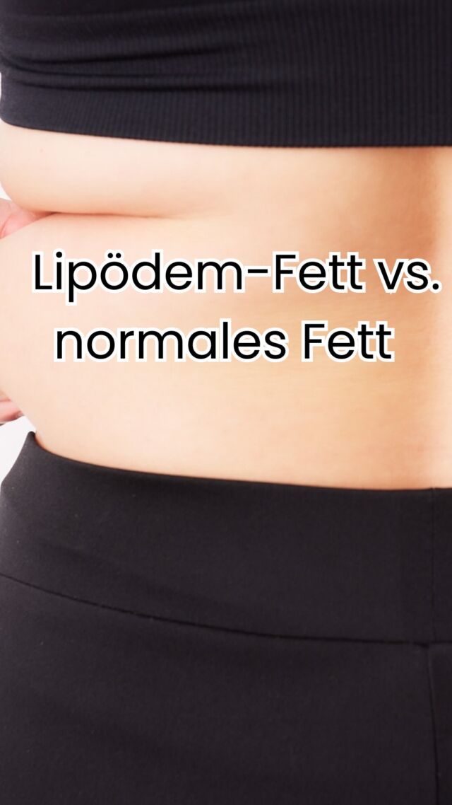 💡 Lipödem-Fett vs. normales Fett – wo liegt der Unterschied?

Beim Lipödem handelt es sich nicht um „normales“ Fettgewebe.
👉 Lipödem-Fett ist krankhaft vermehrt, schmerzempfindlich und verteilt sich typischerweise symmetrisch an Beinen und Armen – unabhängig vom Körpergewicht.
👉 Normales Fettgewebe dagegen reagiert auf Ernährung und Bewegung und ist nicht schmerzhaft.

Das Wichtigste: Ein Lipödem ist keine Folge von Übergewicht und sollte medizinisch ernst genommen und individuell behandelt werden. 🩺✨

✨ Beste Qualität und höchste Sicherheit durch Klinikstandard ✨

☎️ +49 7741 835 825
📧 Info@klinik-schwarzwald.com
📍Klinik am Schwarzwald
Hauptstr. 31
79787 Lauchringen
🌍 www.klinik-schwarzwald.com

#Lipödem #LipedemaAwareness #PlastischeChirurgie #Fettabsaugung #MedizinWissen #ÄsthetischeChirurgie #LipödemBehandlung