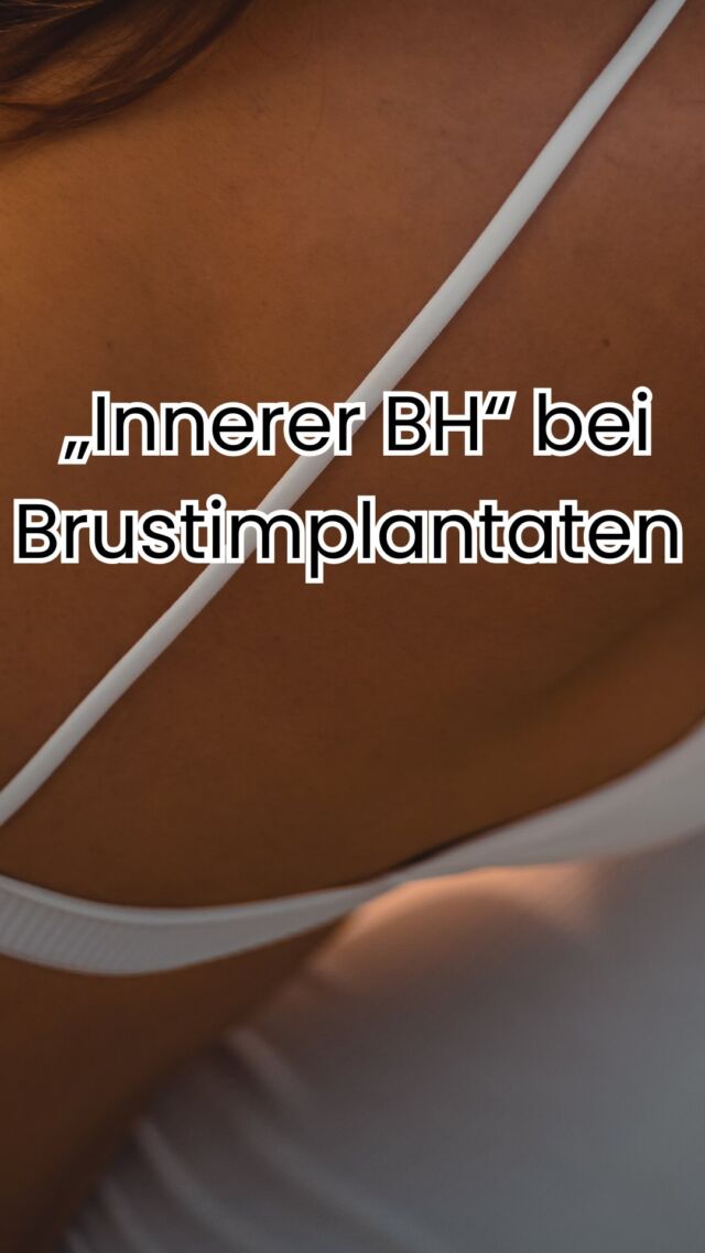 Der "Innere BH" – Mehr als nur eine Brustvergrößerung! ✨

Die Innere BH Technik ist eine innovative Methode bei der Brustvergrößerung mit Implantaten, die für ein besonders stabiles und langanhaltendes Ergebnis sorgt.

Was steckt dahinter?

• Stützendes Gerüst: Das Implantat wird komplett unter alle 4 Brustwandmuskeln gelegt, was eine schützende und stützende Muskelschlinge bildet.

• Muskelschlinge & Nähte: Spezielle Nahttechniken und die Modellierung des Gewebes schaffen eine innere "Hängematte", die dem Absinken entgegenwirkt.

• Verstärkung (optional): Bei Bedarf kann zusätzlich ein resorbierbares Netz (z.B. GalaFLEX) eingesetzt werden, um die Stütze im unteren Bereich weiter zu festigen.

🛡️ PU-Implantate: Das Extra an Halt und Sicherheit

Wir setzen auf Polyurethan-beschichtete (PU) Implantate, um diesen Effekt zu maximieren:

• Fester Halt: Die Microthane®-Oberfläche der PU-Implantate verzahnt sich mikroskopisch mit dem umliegenden Gewebe. Das ist der entscheidende Unterschied!

• Stützfunktion: Durch diese feste Anhaftung wird das Implantat sicher an Ort und Stelle fixiert und kann nicht verrutschen oder rotieren. Es wirkt wie eine innere "Verankerung", die die Brust von innen stützt und die Langzeitstabilität des Ergebnisses deutlich erhöht.

• Weniger Kapselfibrose: Die spezielle Beschichtung reduziert nachweislich das Risiko der Kapselfibrose (Gewebeverhärtung um das Implantat) auf ein Minimum.

➡️ Das Ergebnis: Formstabile, natürlich aussehende Brüste mit langfristigem Halt!

✨ Beste Qualität und höchste Sicherheit durch Klinikstandard ✨

☎️ +49 7741 835 825
📧 Info@klinik-schwarzwald.com
📍Klinik am Schwarzwald
Hauptstr. 31
79787 Lauchringen
🌍 www.klinik-schwarzwald.com

#InnereBH #Brustvergrößerung #PolyurethanImplantate #BrustOP #Microthane #ÄsthetischeChirurgie
#Brustchirurgie #brustimplantate #ÄsthetischeChirurgie #PlastischeChirurgie #Mammaaugmentation