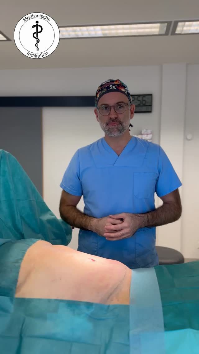 Fleur-de-Lis-Abdominoplastik – medizinischer Eingriff

In diesem Reel sehen Sie einen ärztlich durchgeführten operativen Eingriff aus dem Bereich der plastischen Chirurgie.
Gezeigt wird das Ergebnis einer Fleur-de-Lis-Bauchdeckenstraffung bei einer Patientin nach massivem Gewichtsverlust von rund 60 kg nach bariatrischer Operation.
Bei dieser speziellen Technik wird überschüssiges Haut- und Fettgewebe horizontal und vertikal entfernt. Sie eignet sich insbesondere dann, wenn ein Hautüberschuss sowohl in der Länge als auch in der Breite besteht.
In diesem Fall wurden insgesamt etwa 2 Kilogramm Haut- und Fettgewebe entfernt, um eine stabile, harmonische Bauchkontur zu erreichen.
⚠️ Hinweis:
Bei dem dargestellten Inhalt handelt es sich um eine medizinische Indikation. 
iCD- 10 Code: R63.4; L98.7

✨ Beste Qualität und höchste Sicherheit durch Klinikstandard ✨

☎️ +49 7741 835 825
📧 info@klinik-schwarzwald.com
📍 Klinik am Schwarzwald
Hauptstr. 31
79787 Lauchringen
🌍 www.klinik-schwarzwald.com

#Bauchdeckenstraffung
#FleurDeLis
#PlastischeChirurgie
#KlinikamSchwarzwald
#Klinikstandard