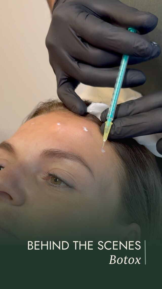 Kunstvolles Injizieren für natürliche Gesichtsharmonie

Bei der Behandlung mit Botox steht nicht das „Glattsein“ im Vordergrund, sondern ein harmonischer, frischer Gesichtsausdruck.
Durch präzises Injizieren entspannt Botox gezielt die Muskulatur, die für Mimikfalten verantwortlich ist – etwa an Stirn, Augen oder zwischen den Augenbrauen.
Dr. Holdenried plant jede Behandlung individuell und abgestimmt auf die persönliche Gesichtsstruktur und die Wünsche der Patientin. Ziel ist stets ein natürlich wirkendes Ergebnis, das die Mimik erhält und die Persönlichkeit unterstreicht.
Im Reel sehen Sie eine Botoxbehandlung, wie sie bei uns durchgeführt wird: medizinisch fundiert, präzise und mit ästhetischem Feingefühl.

✨ Beste Qualität und höchste Sicherheit durch Klinikstandard ✨

☎️ +49 7741 835 825
📧 info@klinik-schwarzwald.com
📍 Klinik am Schwarzwald
Hauptstr. 31
79787 Lauchringen
🌍 www.klinik-schwarzwald.com

#Botox
#ÄsthetischeMedizin
#DrHoldenried
#KlinikamSchwarzwald
#Klinikstandard